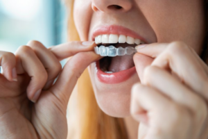 Close up of woman inserting Invisalign tray