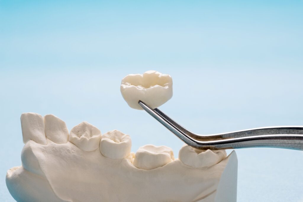 Dental crown grasped with forceps being placed over model tooth